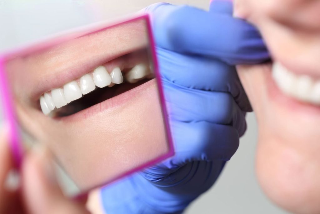 Cosa mangiare dopo un impianto dentale